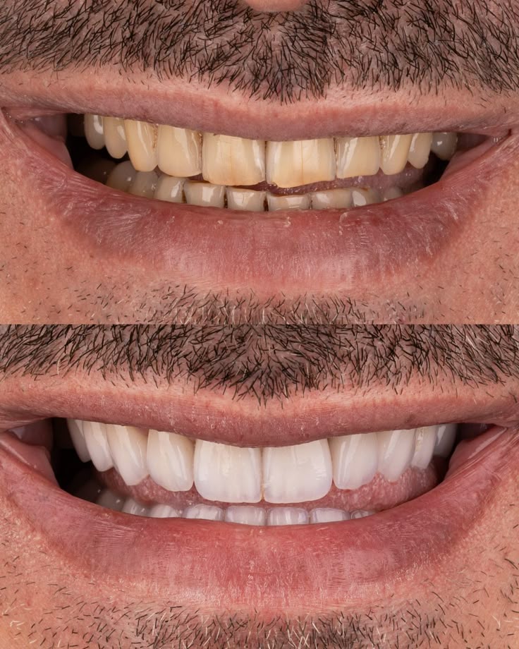Before and after dental transformation