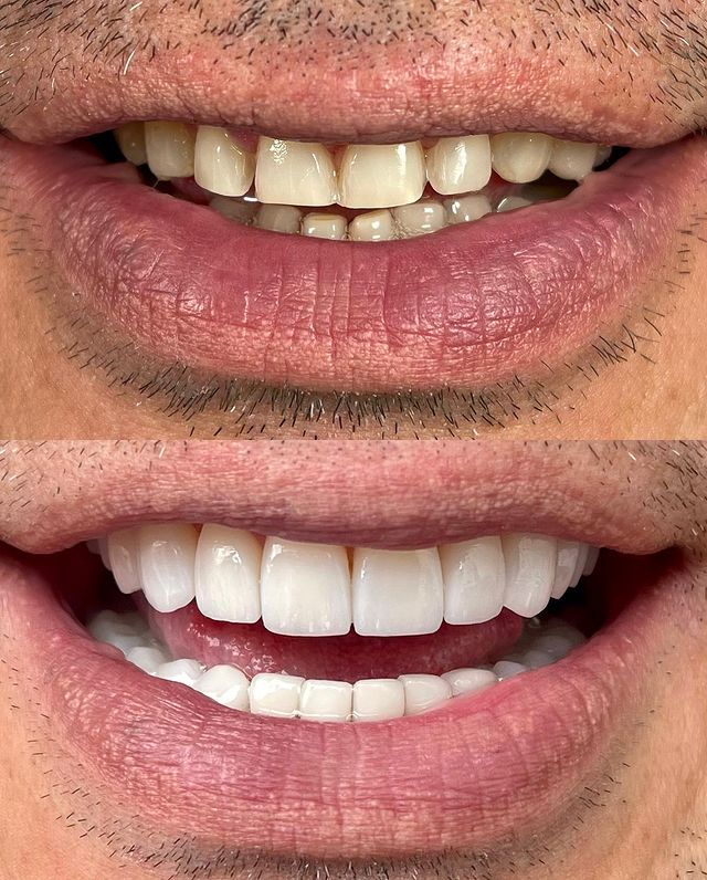 Before and after dental transformation